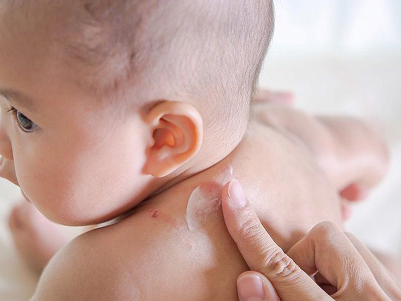 Yenidoğanlarda Cilt Döküntüleri: Neden Olur ve Nasıl Yönetilir?